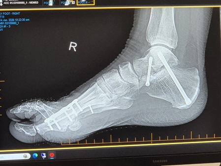 Two screws fusing the subtalar joint of my ankle